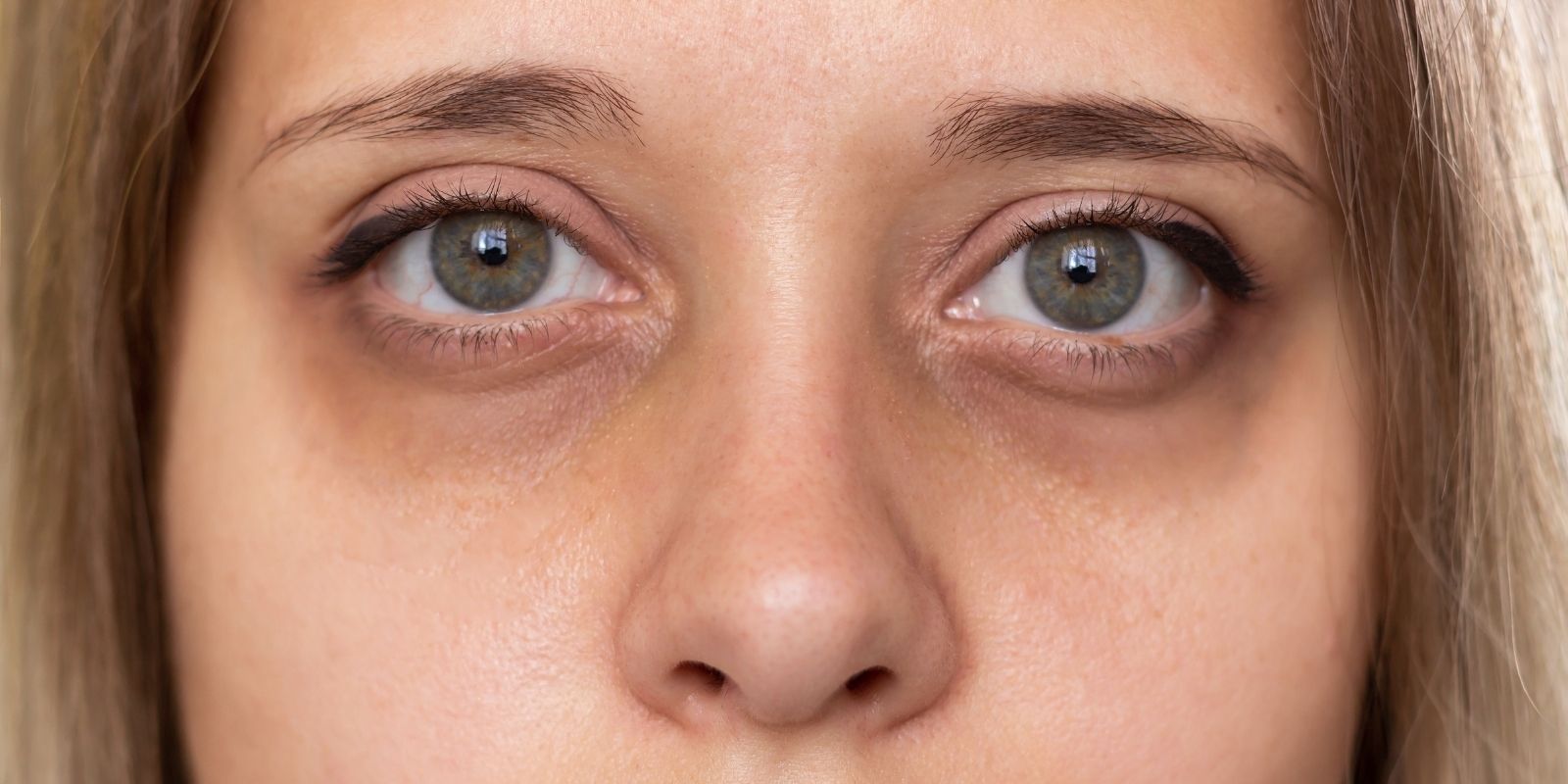 The Science Behind Dark Circles and Puffy Eyes - Aloeo